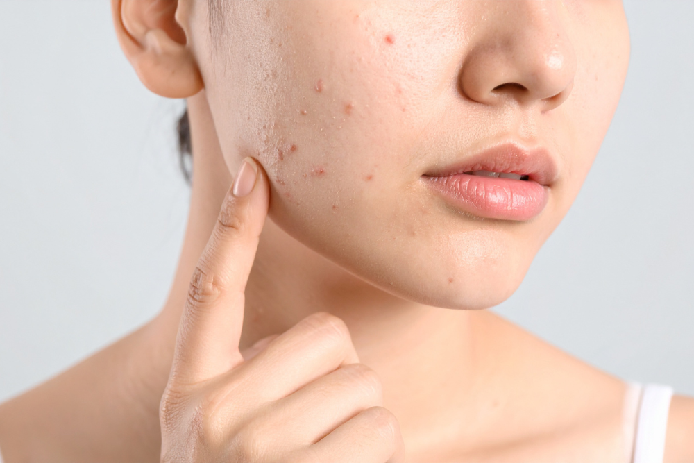period-acne.png